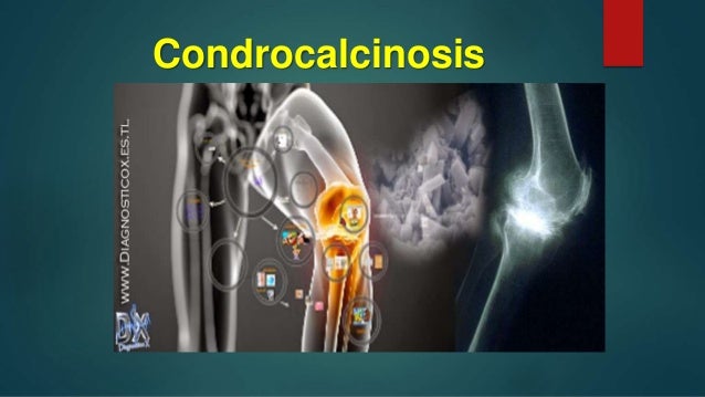 condrocalcinosis pseudogota